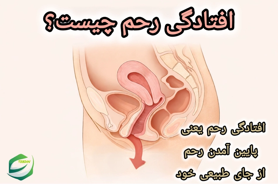افتادگی رحم 2 افتادگی رحم چیست ؟