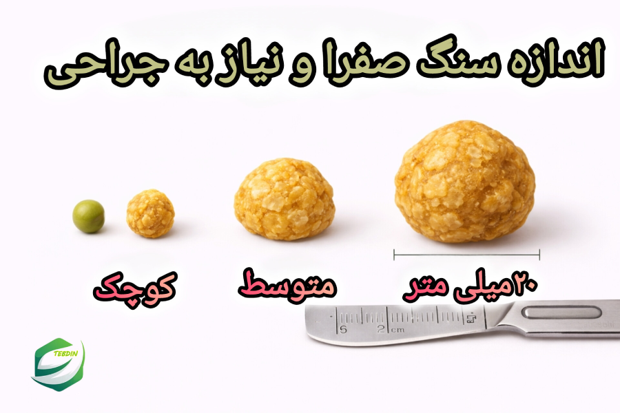 اندازه سنگ صفرا و نیاز به جراحی