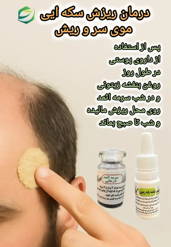 درمان ریزش سکه ایی موی سر و ریش با داروی پوستی مالیدنی