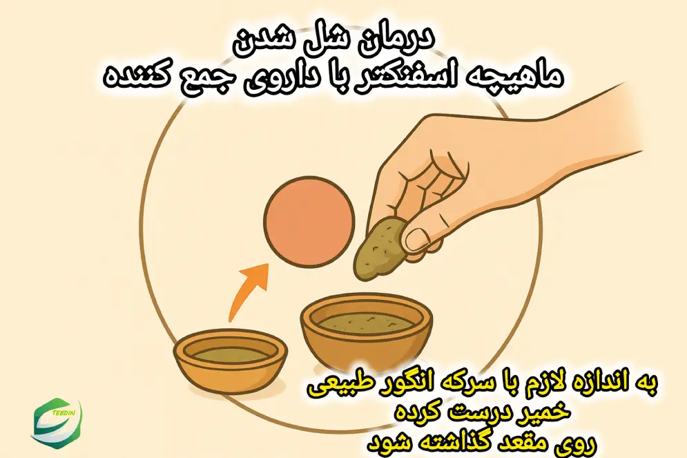 درمان شل شدن ماهیچه اسفنکتر با داروی جمع کننده