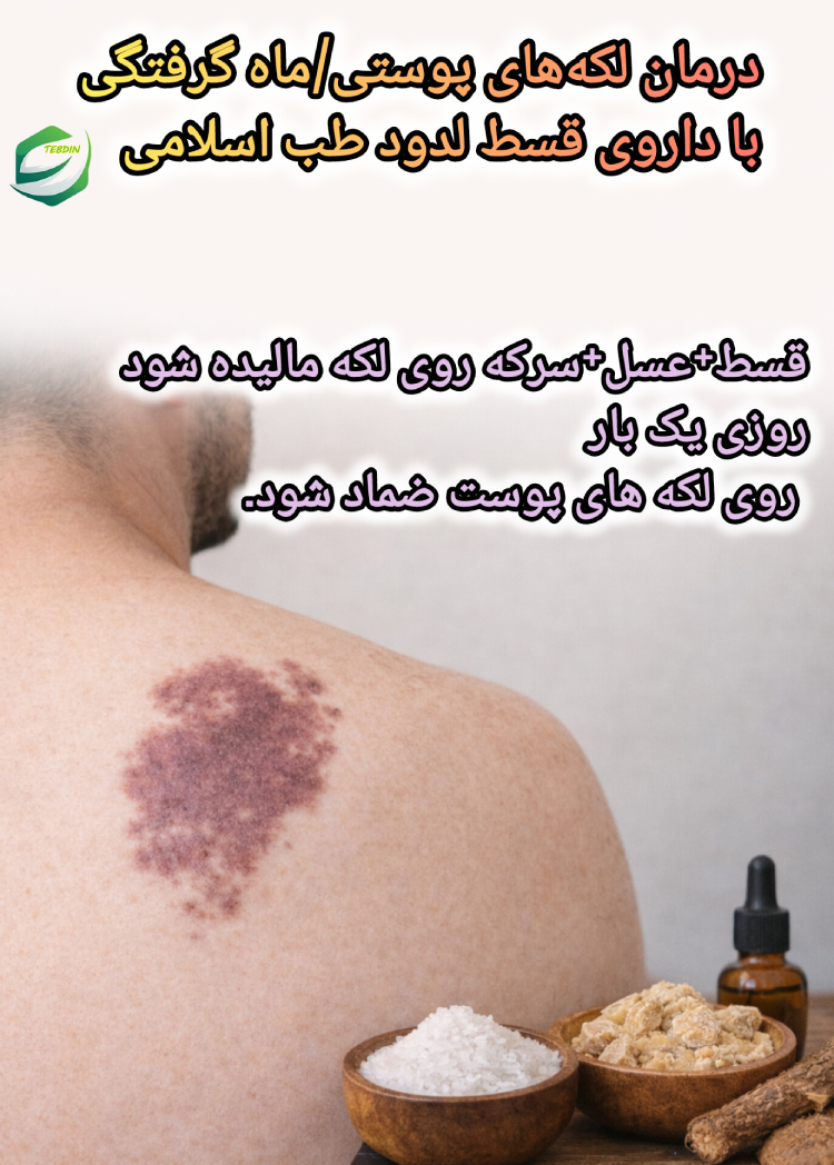 درمان لکه های پوستی ماه گرفتگی با داروی قسط لدون طب اسلامی