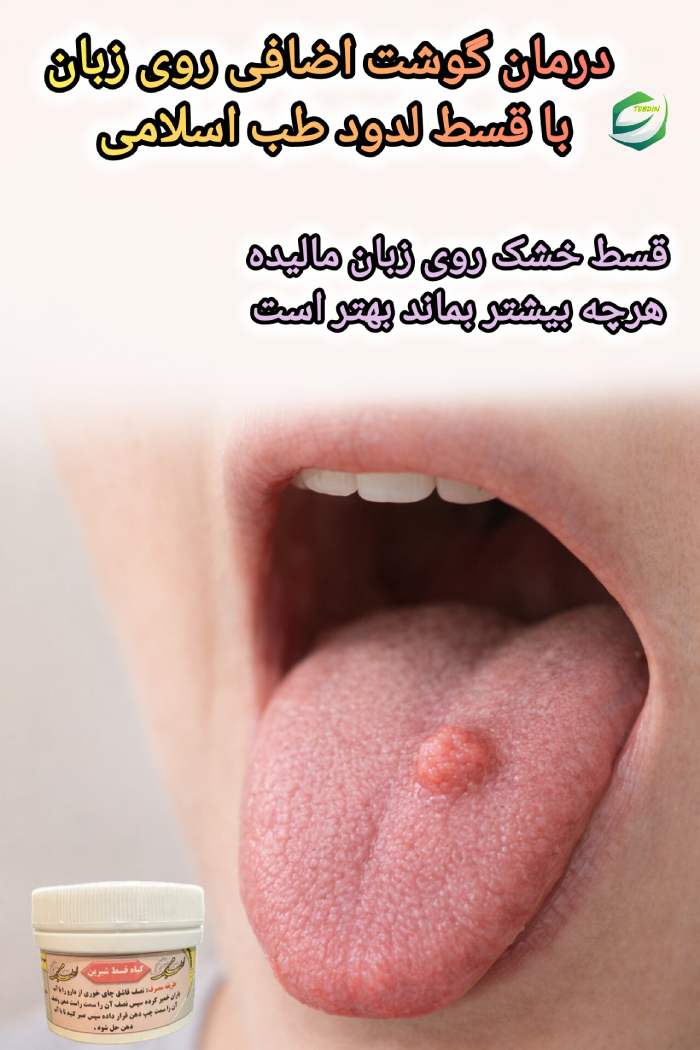 درمان گوشت اضافی روی سطح زبان با داروی قسط لدودطب اسلامی