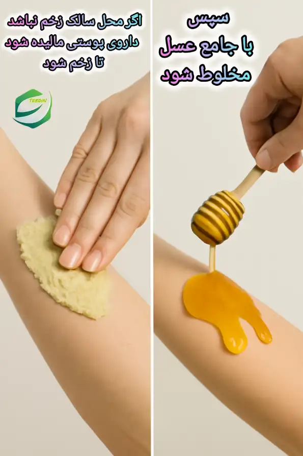 دستور مصرف داروی پوستی مالیدنی برای سالک
