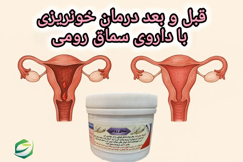 قبل و بعد درمان خونریزی با داروی سماق رومی
