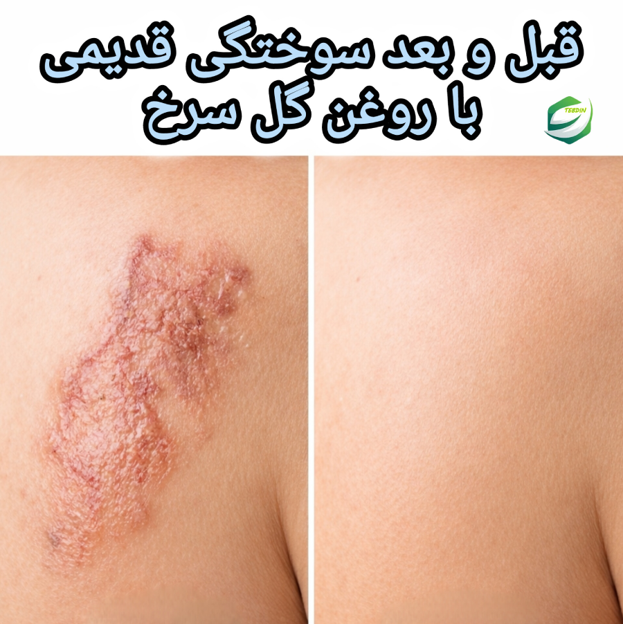 روغن گل سرخ 5 قبل و بعد سوختگی قدیمی با روغن گل سرخ