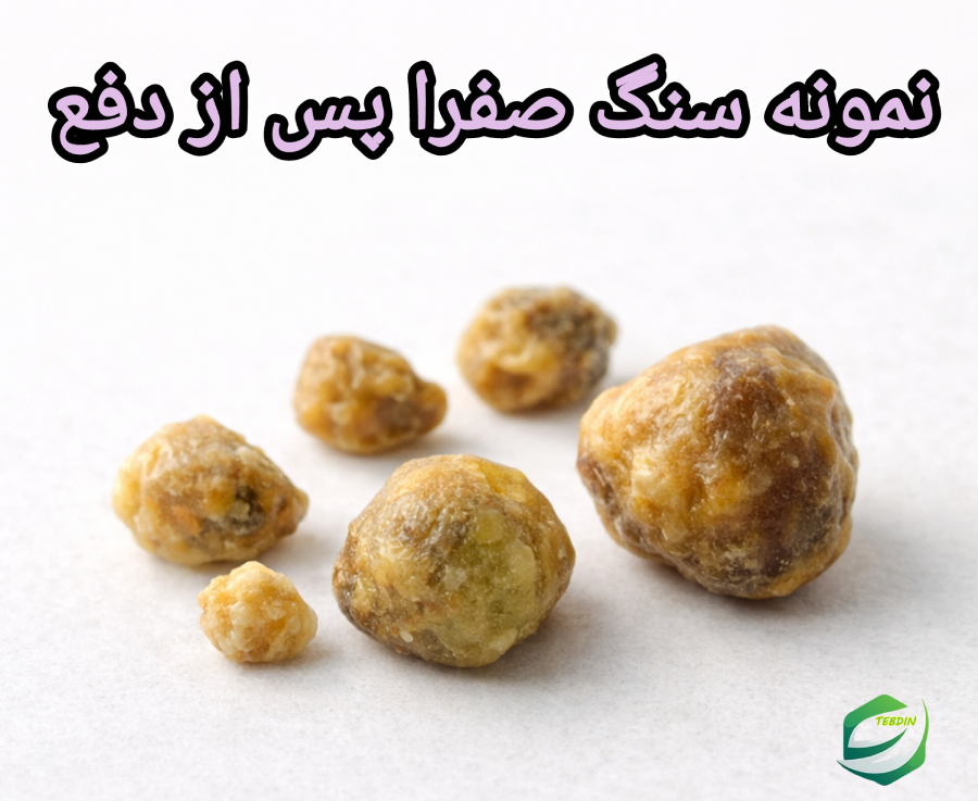نمونه سنگ صفرا پس از دفع
