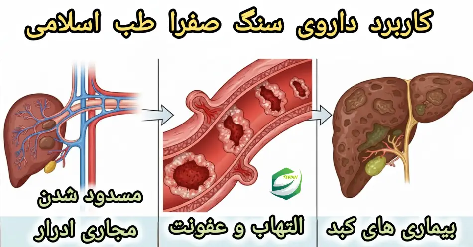 کاربردداروی سنگ صفرا طب اسلامی