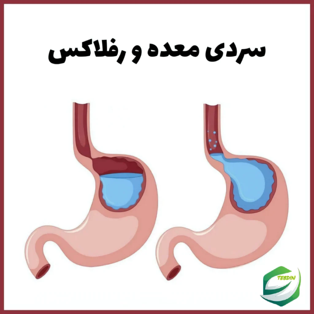 رفلاکس سردی معده