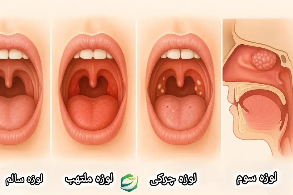 تفاوت بین لوزه ها
