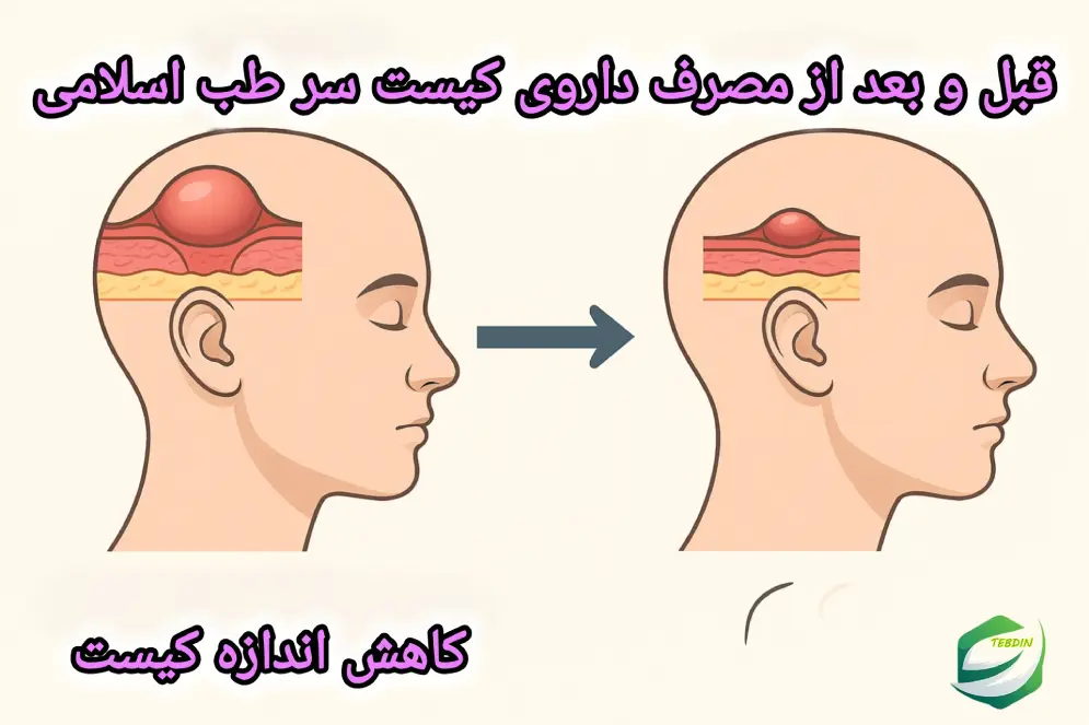 قبل و بعد از مصرف داروی کیست سر طب اسلامی