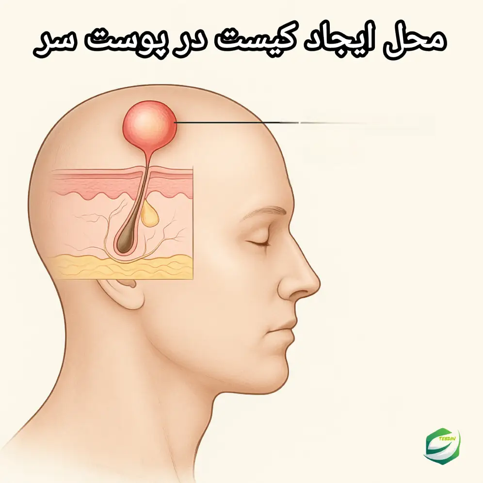 محل ایجاد کیست در پوست سر