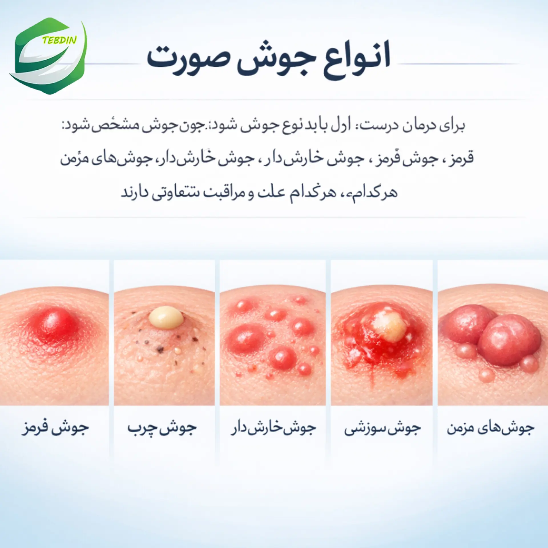 انواع جوش صورت