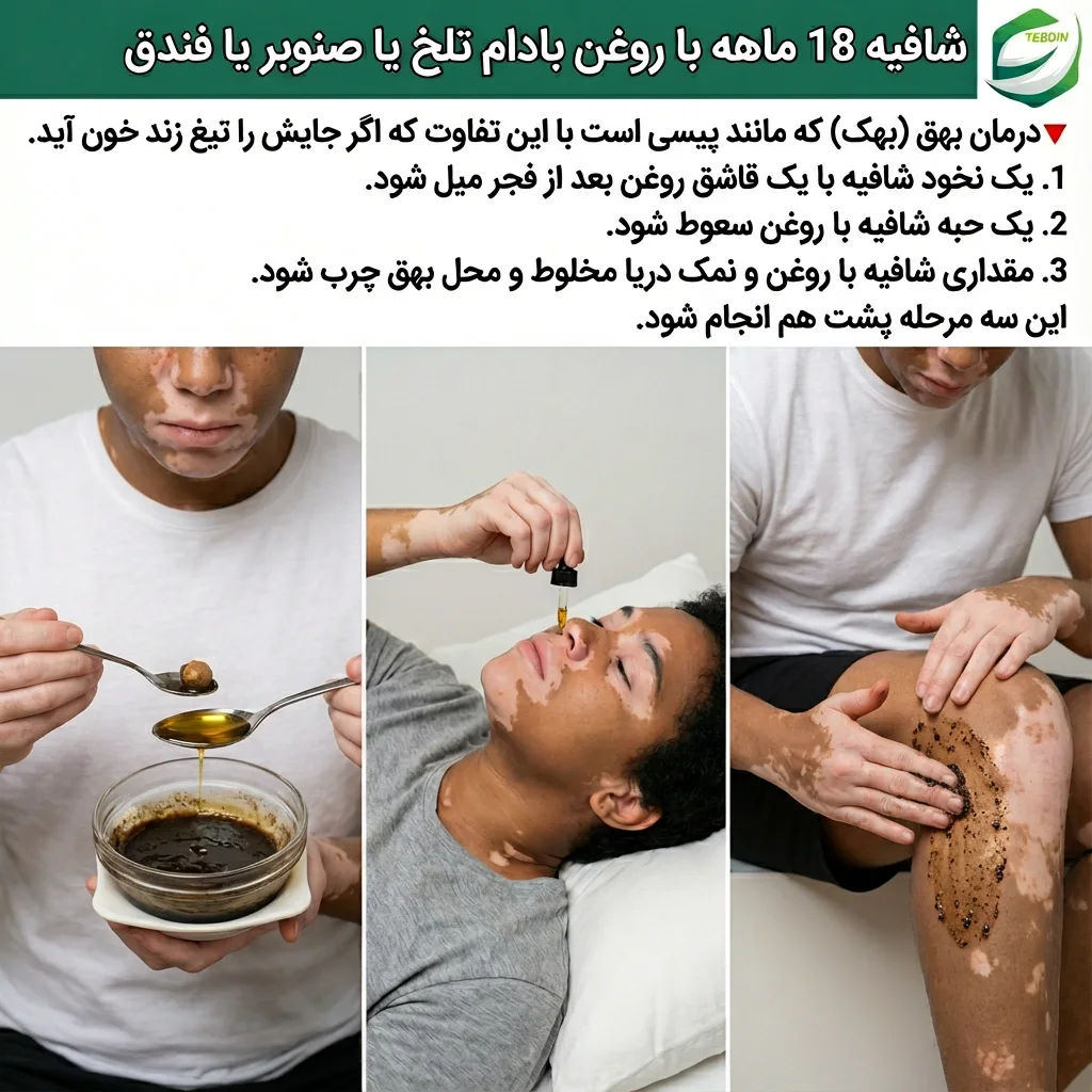 شافیه با روغن بادام تلخ درمان پیسی